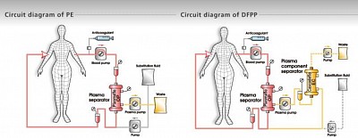 Plasmapheresis 