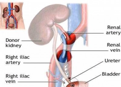 Grafted kidney in right iliac fossa.