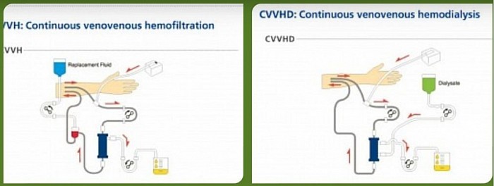 CVVH and CVVHD