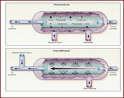 Artificial kidney