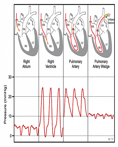 Right sided pressures