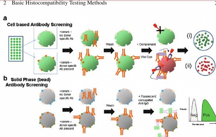 llustration of HLA typing: Schematic diagram of cell based and solid phase (bead based) antibody screening.  ( a) Two representative wells are illustrated from the panel of cells that is used. Serum is added to  each well in the panel. On the  top the antibody in the serum does not bind to the cells on the bottom do nor specific antibody (DSA) does bind. Bound DSA remain after wash steps, so that  when complement is added, it forms the membrane attack complex, killing the cell and allowing  the vital dye is taken up by and visualized. No donor specific antibody leaves live cells (i), and  when DSA are present, the vital dye identifies the dead cells (ii). ( b ) Serum is added to be adscoated with purified or recombinant HLA antigen. In this case, the antibody in the serum is only specific  to the bead on the  bottom. Only beads with DSA already bound will bind the secondary fluorescent  anti-IgG marker. Increased fluorescence defines positive beads with DSA bound to them.