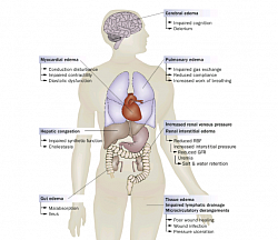 Pathologic sequelae of ﬂuid overload in organ systems. Abbreviations: GFR, glomerular ﬁltration rate; RBF, renal blood  ﬂow.