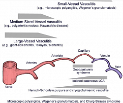 Primary Vasculitis classification (Picture de-classico): inflammation of blood vessels, causing wall thickening, stenosis, and occlusion with ischemia. Necrotizing inflammation that destroy segments of the wall. Vessels of any size of any organ system can involve. The disease depends on type of inflammation, the size of blood vessel segment, and the organ. Secondary vasculitis can result from other autoimmune disease, malignancy, allergies etc. ANCA are directed against granular and lysosomal constituents of neutrophils and monocytes. Two fluorescence pattern —a cytoplasmic ANCA (C-ANCA) and a perinuclear ANCA (P-ANCA) staining pattern.