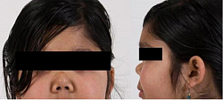 Saddle nose of Wagener Granulomatosis Currently known as Granulomatosis with polyangiitis (GPA).   Granulomatous vasculitis that involves the sinopulmonary system but can involve any organ system. Presenting features may include purpuric rash, recurrent sinusitis, epistaxis, shortness of breath, and/or hemoptysis from alveolar hemorrhage and necrotizing glomerulonephritis with significant renal impairment, have a positive ANCA finding in 90% of cases, (c-ANCA, or anti-PR3).