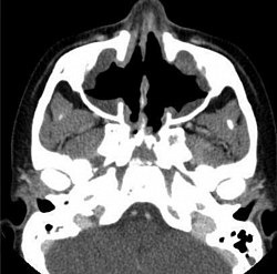 Paranasal sinuses showing erosion & loss of sinus wall.Criteria for GPA include 3 of the following 6 features: 1.hematuria and/or significant proteinuria, 2. Granulomatous inflammation on biopsy (shows necrotizing pauci-immune glomerulonephritis.) 3. Nasal sinus inflammation  4. Subglottic, tracheal, or endobronchial stenosis, 5. Abnormal chest radiography or CT findings, 6. PR3 ANCA or c-ANCA staining in WG.