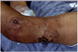 Necrotizing nodules of Cutaneous Polyarteritis Nodosa. neuropathy, and myalgia. Note that renal involvement does not manifest as glomerulonephritis, as occurs with small-vessel disease. Skin involvement (eg, livedo reticularis, tender subcutaneous nodules, other vasculitic lesions).