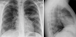 Chest x-ray of pulmonary infiltrates in Churg Strauss Syndrome (CSS). Churg-Strauss syndrome (CSS) is an eosinophilic granulomatous vasculitis characterized predominantly by pulmonary involvement. Patients typically have a previous history of asthma, allergic rhinitis, and/or sinusitis. A characteristic feature is the finding of nonfixed pulmonary infiltrates.
