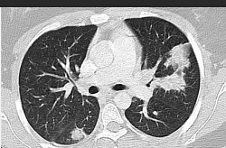 Eosinophilic infiltration results in multiorgan involvement, including neuropathy and cardiovascular disease (pericarditis). ANCA positivity is seen in approximately 40% of patients, usually with an “atypical” or “indeterminate” pattern.