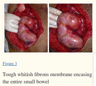 EPS S/P Dissection