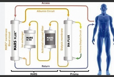 MARS: Blood-Albumin circuit (outer), Albumin-Dialysate circuit (inner) with Charcoal & Ion Exchange resin chamber.